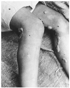Blisters on the legs of a Chinese soldier after exposure to mustard gas in 1941. ©BETTMANN/CORBIS.
